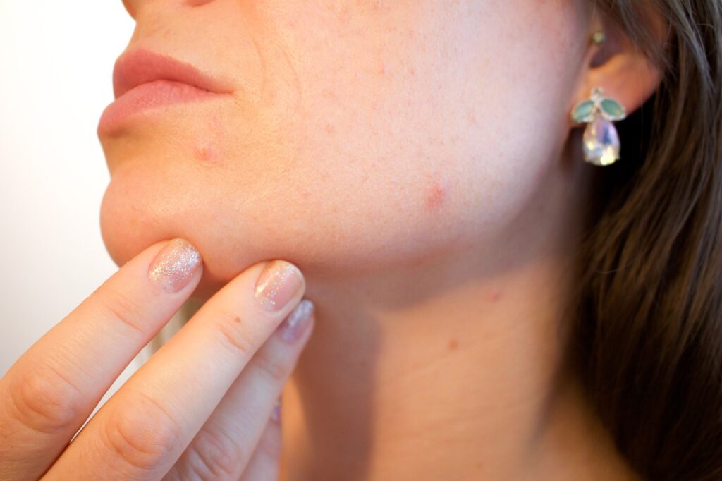 acne, pores, skin