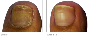 Laser toenail fungus treatment – Hudes Laser Aesthetica